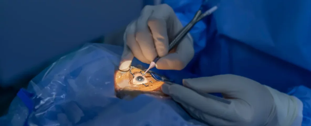 LASIK Eye Surgery
